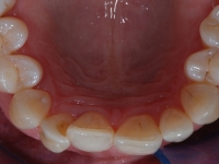 1-before-treatment