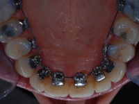 Lingual Braces attached to the back of the teeth.