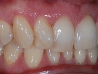 Treatment begins with Lingual Braces