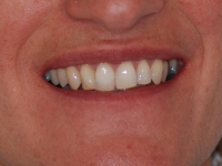 Invisible Braces Smile